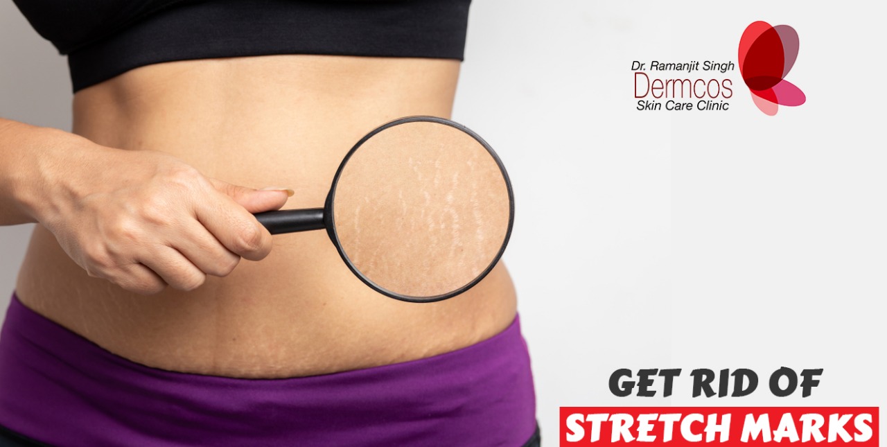 You are currently viewing Methods of Demarking your stretch marks!