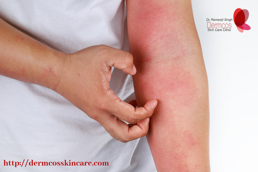 Read more about the article Why Atopic Dermatitis Can Be Complicated?