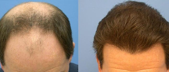 Read more about the article PRP for Hair Loss