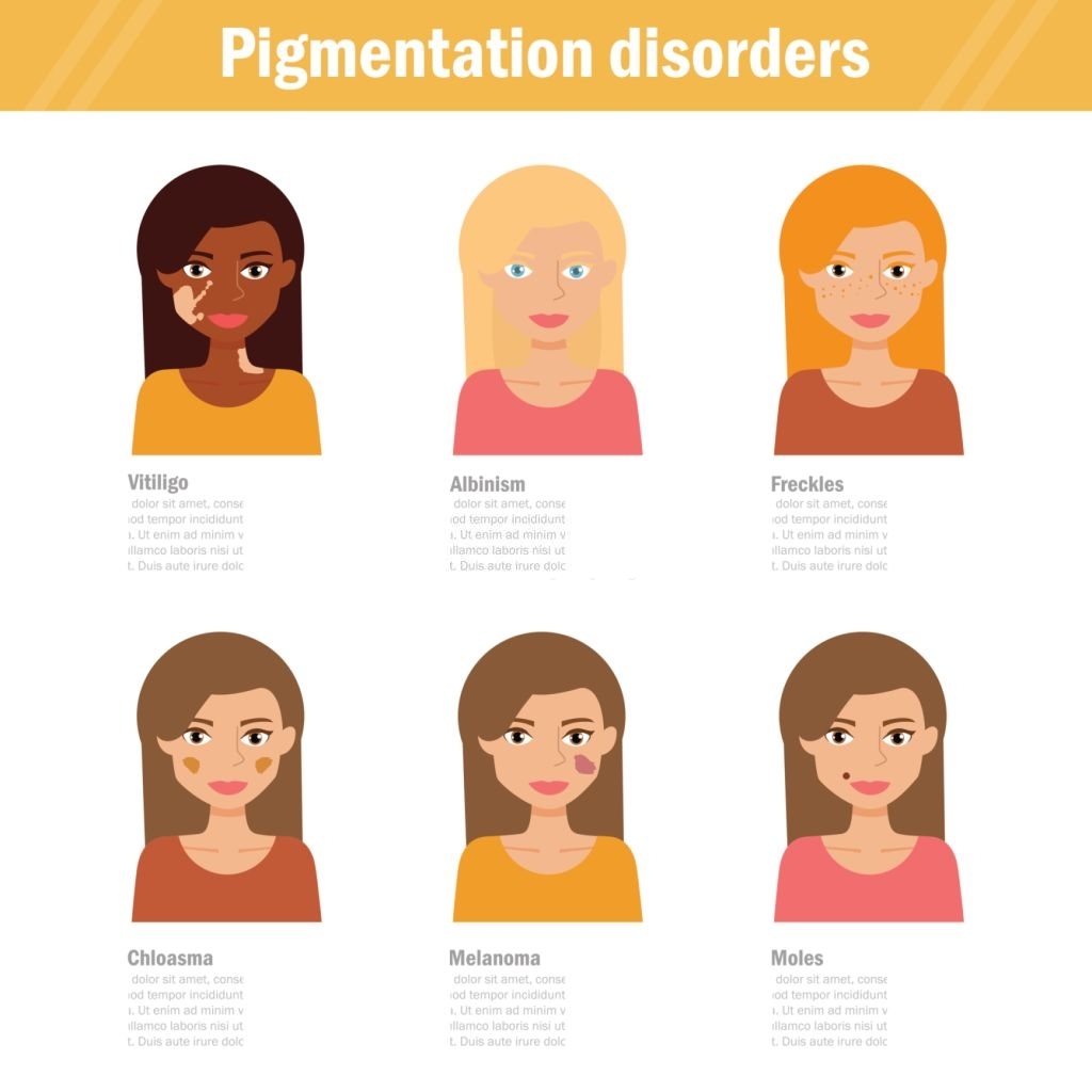 You are currently viewing 5 Myths about Pigmentation