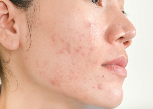 Read more about the article How dermatologists Treat Acne?