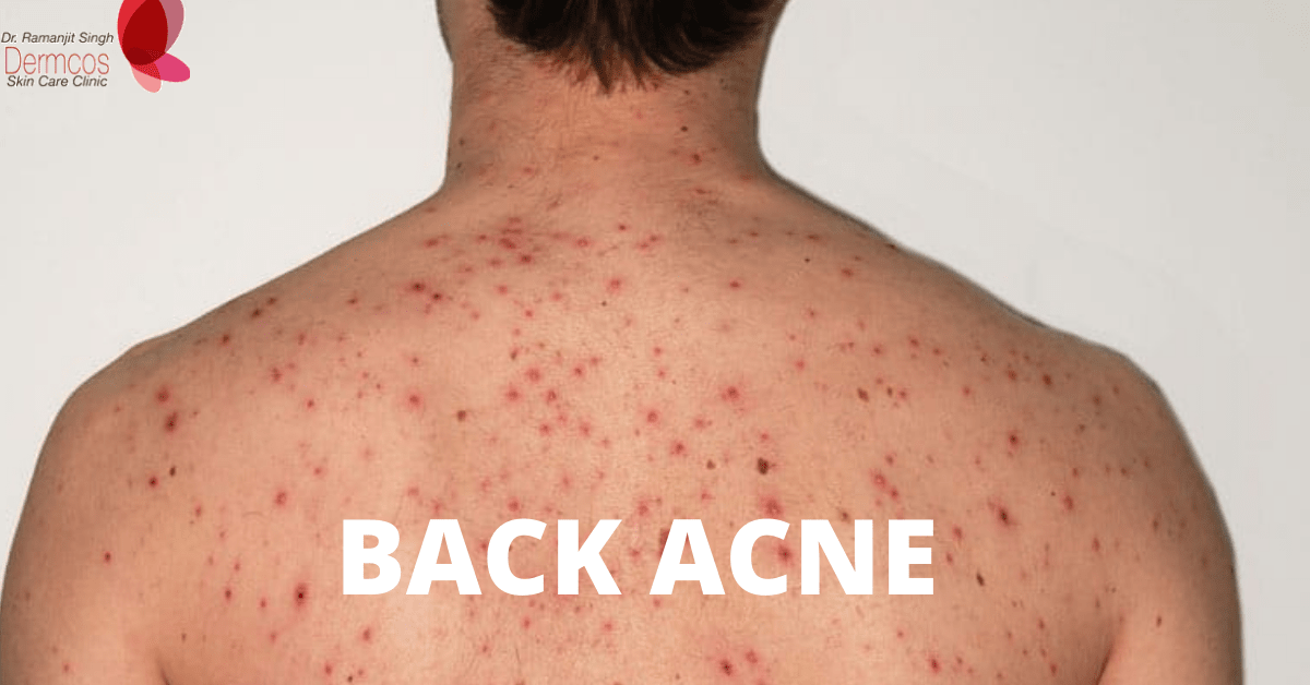 Read more about the article Back Acne: Causes and Treatment