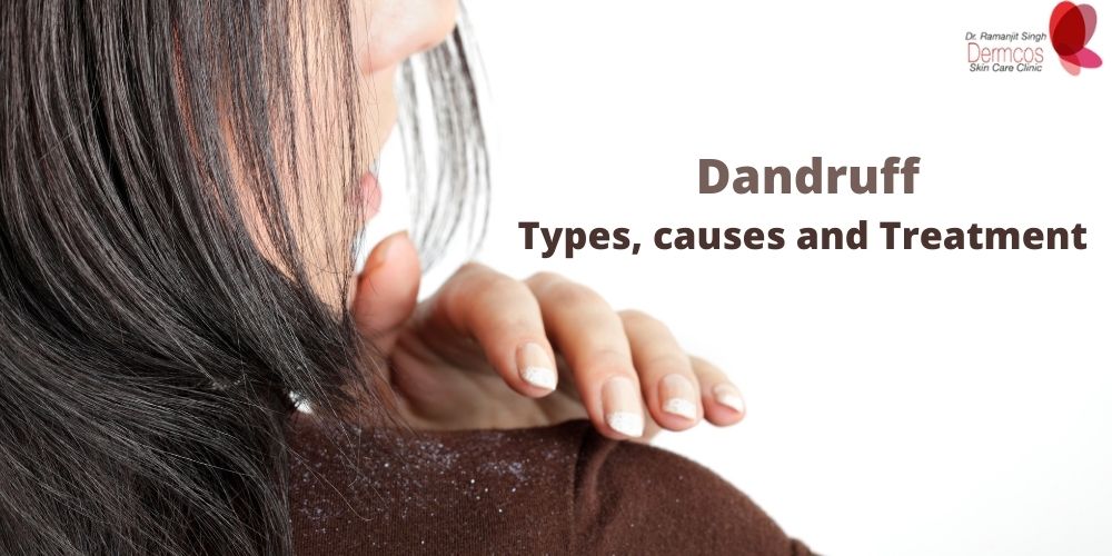 You are currently viewing Different Types Of Dandruff, Treatment And Causes