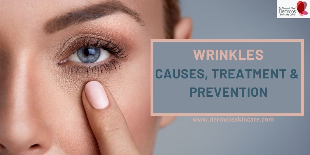 You are currently viewing Wrinkles: Causes, treatment and prevention