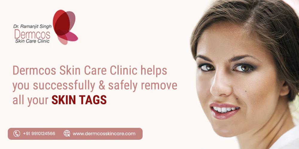 Read more about the article Skin Tag Removal in Gurgaon