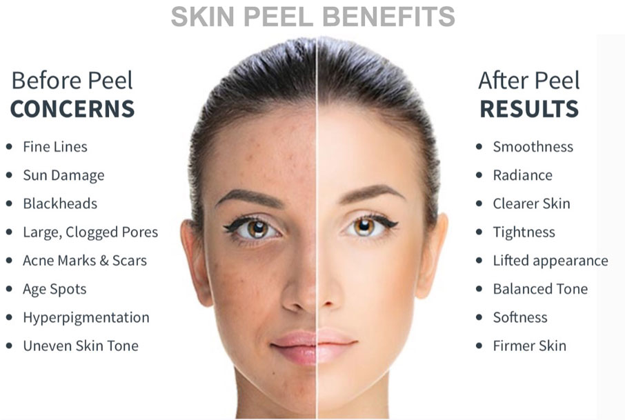 Read more about the article Understanding The Different Types of Chemical Peels and Their Benefits