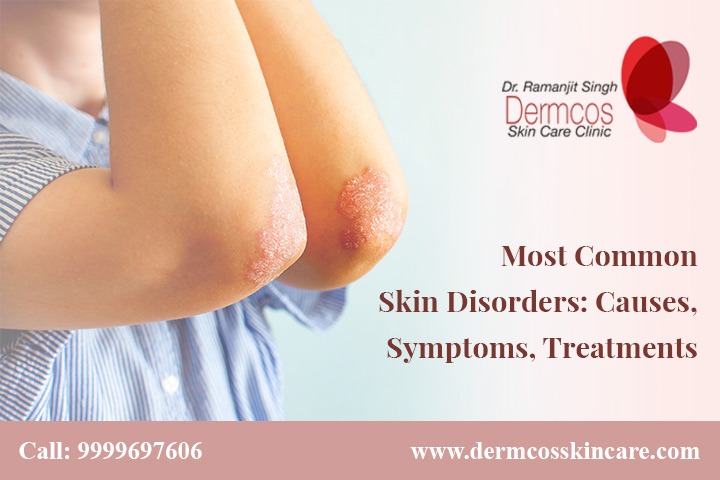 Read more about the article Most Common Skin Disorders: Causes, Symptoms, Treatments