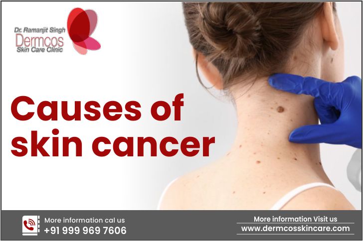 You are currently viewing Causes of Skin cancer